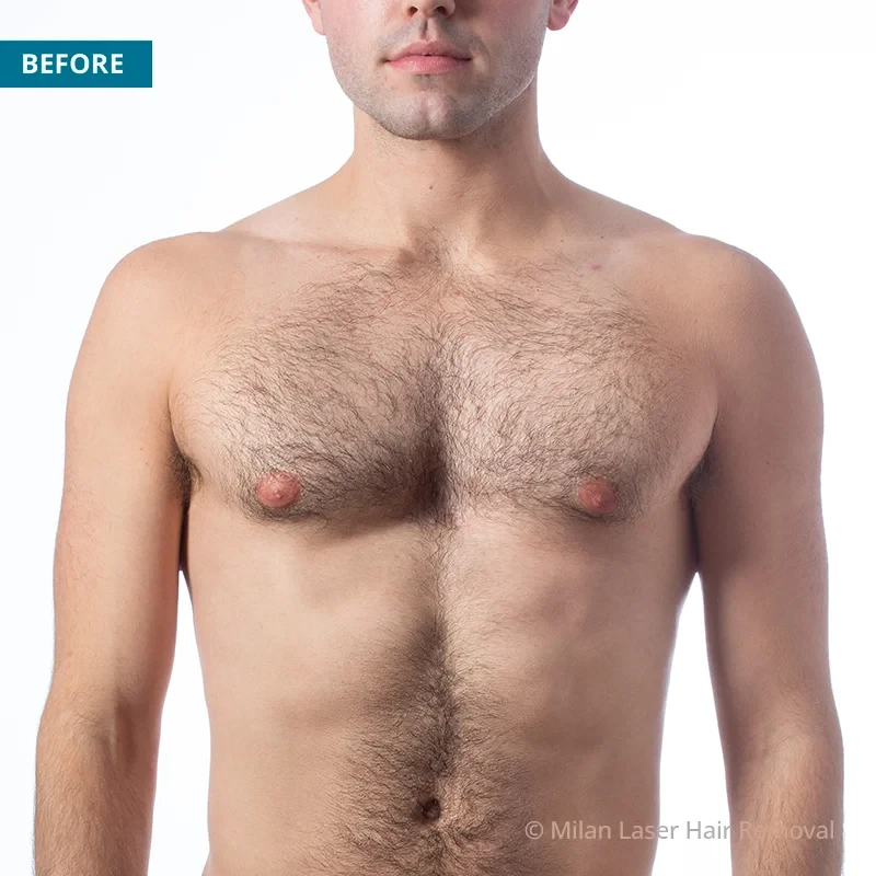 Men's Before & After Photos of Laser Hair Removal | Milan Laser in Tulsa, OK